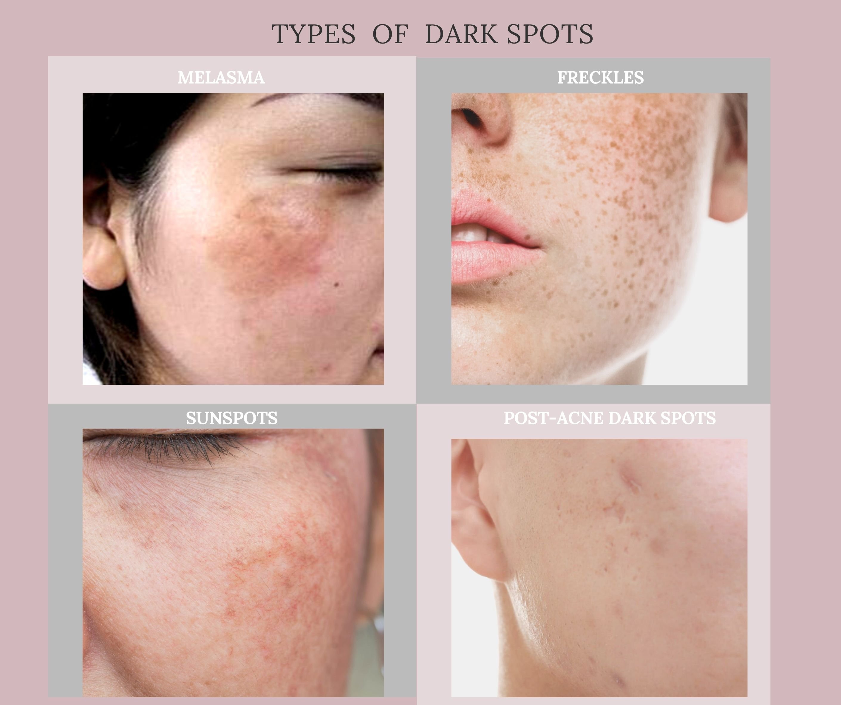 Minimizing age spots and blemishes